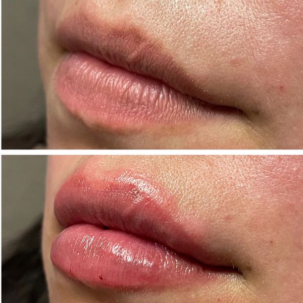 Lip Filler Before and After 3