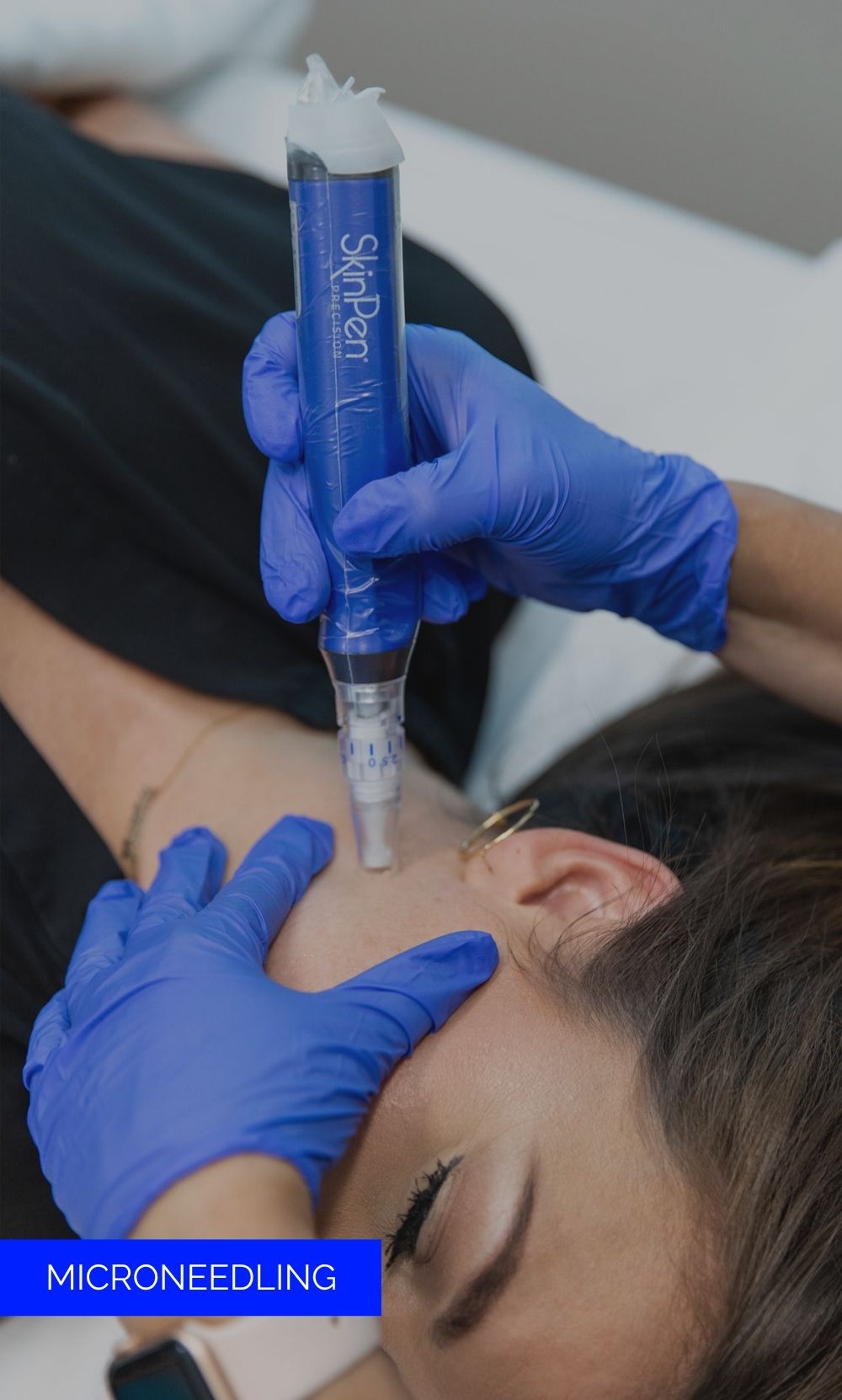 Microneedling